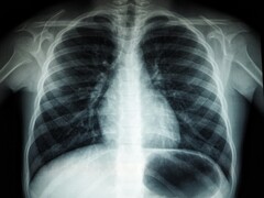 Imagen de rayos X de un torso humano (Fuente de la imagen: Umanoide vía Unsplash; recortada)