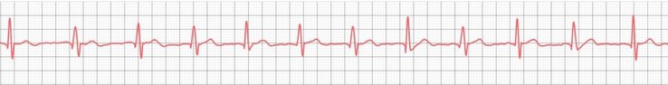 Incluso los relojes inteligentes más económicos han demostrado que pueden registrar con éxito electrocardiogramas básicos