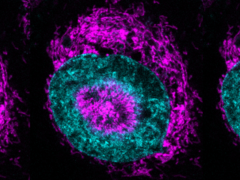 Una célula cancerosa confinada (en la imagen) - se pueden ver las mitocondrias de color magenta acumulándose en la periferia nuclear de color cian y dentro de las hendiduras nucleares. (Fuente de la imagen/capítulo: Rito Ghose y Fabio Pezzano/Centro de Regulación Genómica)