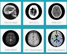El software de IA médica BrainSee de Darmiyan puede detectar precozmente signos de Alzheimer. (Fuente: Darmiyan)
