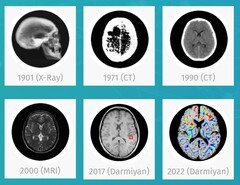 El software de IA médica BrainSee de Darmiyan puede detectar precozmente signos de Alzheimer. (Fuente: Darmiyan)