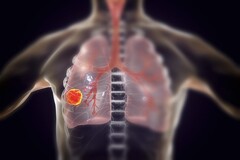 Sólo en 2022, 131.888 personas murieron de cáncer de pulmón en EE UU. (Fuente de la imagen: KATERYNA KON/SCIENCE PHOTO LIBRARY/Getty Images)