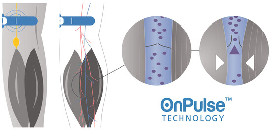 OnPulse (Fuente de la imagen: Sky Medical)